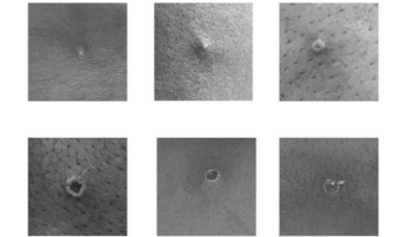 Infectados por Viruela del mono